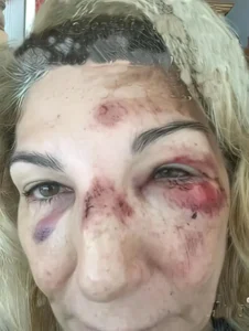 Close-up do rosto de Ana Méndez-Ferrell mostrando inchaço e hematomas visíveis ao redor do olho esquerdo e nariz.